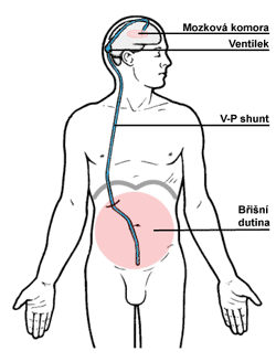 Schéma zavedeného V-P shuntu