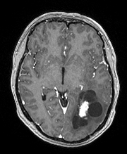 MR nádor mozku