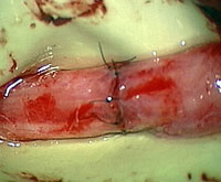 nerv-po-suture